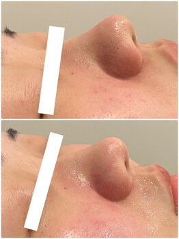 エステサロン ブレス 山形店(BLESS)/フェイシャル結果