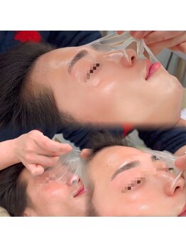 スア(SUA)/3D水光ピーリング施術風景