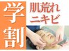 【学割U24】《肌荒れニキビ》学生さんのための全身鍼灸施術60分通常価格¥9900
