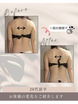 リンガ(Ringa)/ビフォーアフター【腸活ケア】