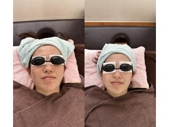 エタニティ 北花田店(Eternity)/【顔脱毛/Eライト】