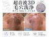 【Byebye角栓！毛穴レス肌へ】全顔★超音波3D毛穴洗浄(ハイドロ) ￥12100→