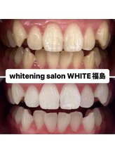 ホワイトニングサロン ホワイト(WHITE)/セルフホワイトニング効果