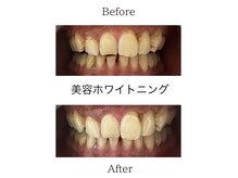 クレン(CLEN)/セルフホワイトニング