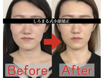 アベックトア(Avectoi)/小顔矯正で左右差が解消できる