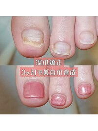 夏に向けて♪フットの深爪矯正