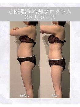 OBSの写真/【－10ｋｇ越え多数！】本気でお腹の脂肪を落としたい方の為の結果にこだわる本気の脂肪冷却プログラム！