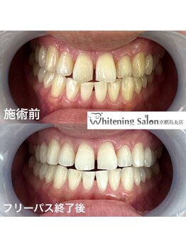 ホワイトニングサロン 京都烏丸店/ホワイトニング施術例