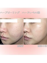 クレアナ ザ ビューティー(KULEANA the beauty)/ハーブピーリング