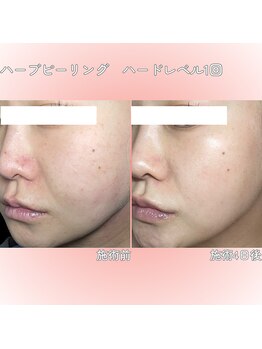 クレアナ ザ ビューティー(KULEANA the beauty)/ハーブピーリング