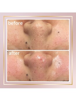 リシェス(Richesse)/毛穴開き☆初回¥9990