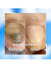 巻き爪補正店 秋葉原店/ 【分厚い爪/変形爪再生補正】