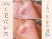 シャングリラ(Shangri-La)/ハイドラ毛穴洗浄