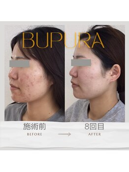 ブプラ 光の森店(BUPURA)/お客様ビフォーアフター