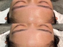 アマト 心斎橋店(Amato)/心斎橋/毛穴洗浄/ワックス脱毛