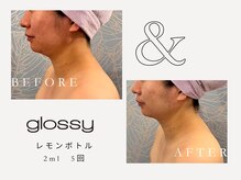 グロッシー(glossy)/【症例レモンボトル顎下30代