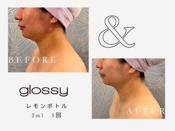 グロッシー(glossy)/【症例レモンボトル顎下30代