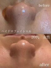 ステライチマルサン(stella.103)/ハイドロ毛穴洗浄