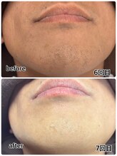 アイズ(I'Z)/ヒゲ脱毛