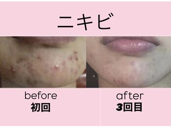 エステティック　レイビス 渋谷店(RAYVIS)/水光ピーリング(ニキビケア)