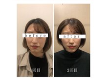 シナジープラス(SYNERGY+)/歪みにも効果的！？