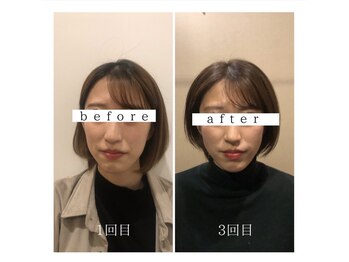 シナジープラス(SYNERGY+)/歪みにも効果的!?