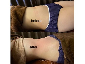 ジャスミン 新宿店(茉莉花)/ハイパーナイフ+キャビお腹施術