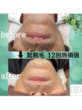 ラ フェリーチェ(La Felice)/ひげ脱毛Before　After（2）
