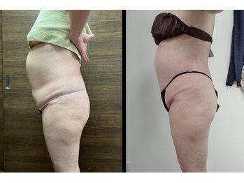 ソフィーム/全身痩身