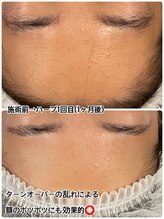 ハーシークレット(Her secret)/ハーブピーリング効果・くすみ