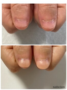 深爪矯正 自爪風