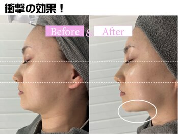 カンナムビューティー 新宿 代々木/小顔矯正リフトで驚きの小顔に！