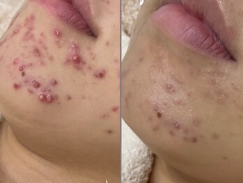 エミュ(emu)/憎きニキビもしっかりケア