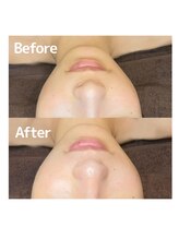 ヴィヴ フォー アール(VIV for R)/肌質改善　30代女性