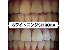 シロハ(SHIROHA)/セルフホワイトニング/天王寺
