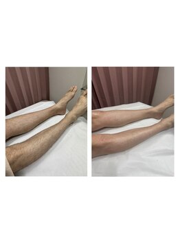 モアラニ(Moalani)/Before→After