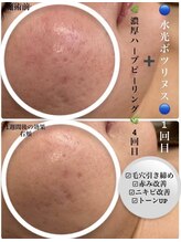 アリュール 倉敷(ALLURE)/【水光ボニックスフェイシャル】