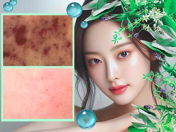 ウィア 越谷店(Uvia)の写真/剥離なしで即美肌になれると韓国でも話題のドクターズハーブ【漢方ハーブピーリング】肌トラブル改善に抜群