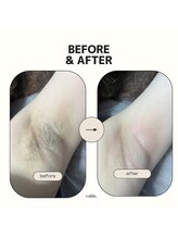 カルム(calm.)/両脇脱毛