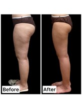 クールヴィラ(Cool Villa)/ヒップ1・太もも3カップ5回左側