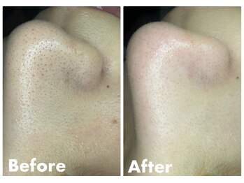 トゥルリア(TRULIA)/いちご鼻鼻撃退プラン！