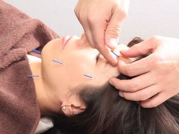 ビプラス(BePlus)の写真/【効果実感◎大人気！美容鍼で育毛促進♪】頭皮のお悩み～慢性疲労まで◎ストレス・自立神経の乱れ改善にも