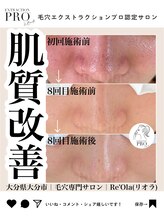 ニュートラル(neutral)/毛穴エクストラクションプロ大分