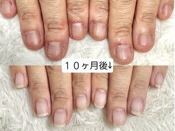 グラシナ なんば店/深爪/自爪育成/フィルイン