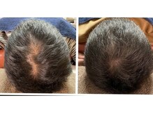 ブライト鍼灸整体院(Bright鍼灸整体院)/頭の鍼施術です。