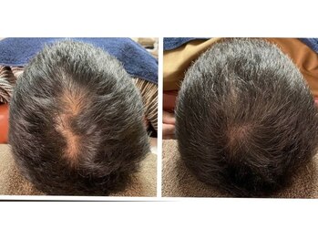 ブライト鍼灸整体院(Bright鍼灸整体院)/頭の鍼施術です。