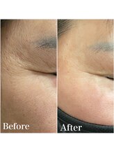 リリー 岐阜店(Lily)/美白マシン効果