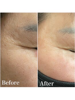 リリー 岐阜店(Lily)/美白マシン効果