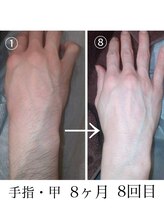 ファスモ(FASMO)/ハンド脱毛