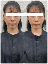 長寿鍼灸院 長寿整骨院/美容鍼25本の効果★小顔効果